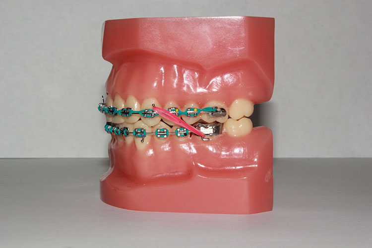 What Can Rubber Bands Do for My Bite? - iSmile Orthodontics