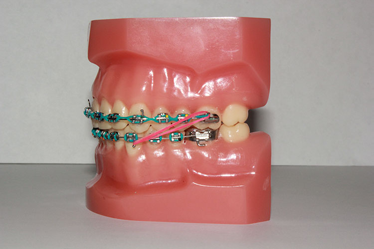 What Your Braces Rubber Band Color Says About You - Orthodontist