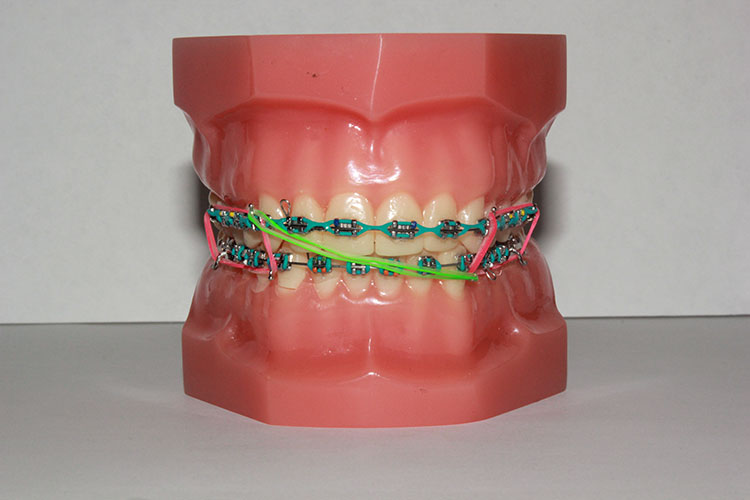 ELASTICS - Orthodontic Specialists