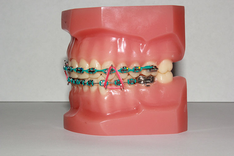 Elastics in orthodontics - Orthodontics in Summary