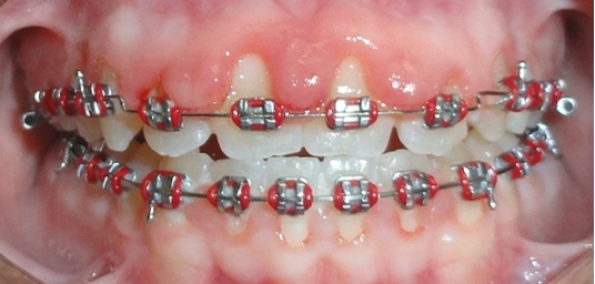Close-up of a person's teeth with braces