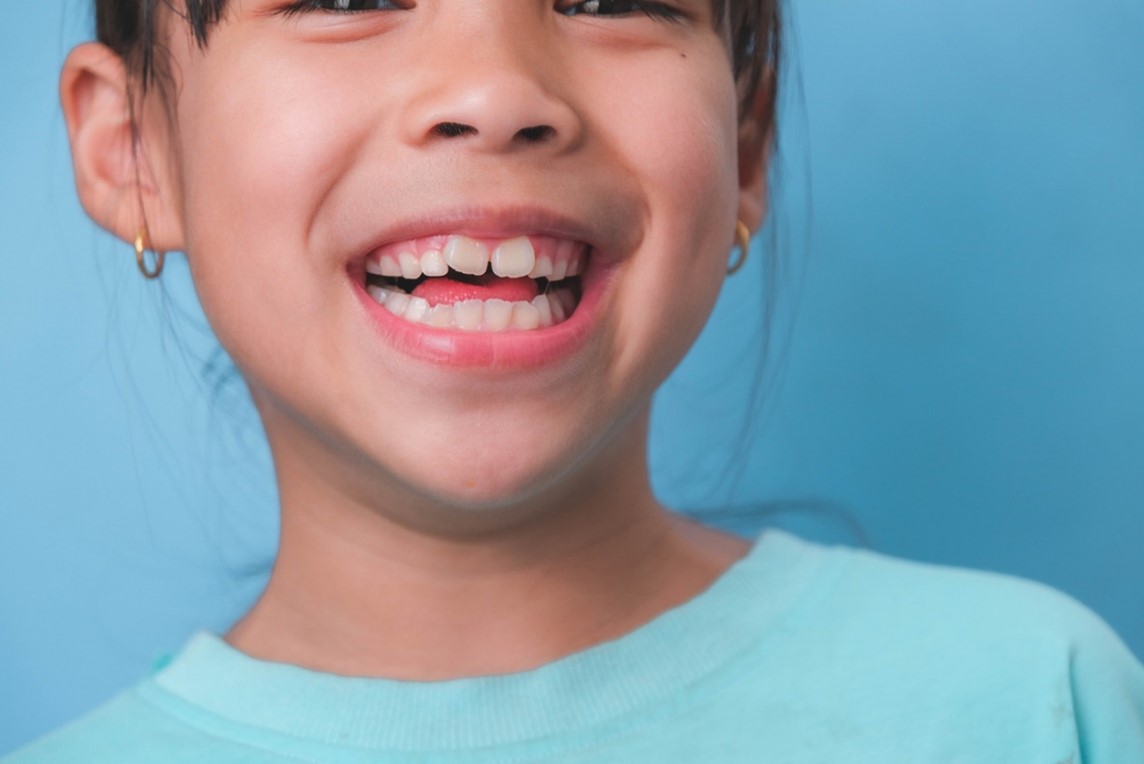 Close-up of a young child smiling, early orthodontic monitoring