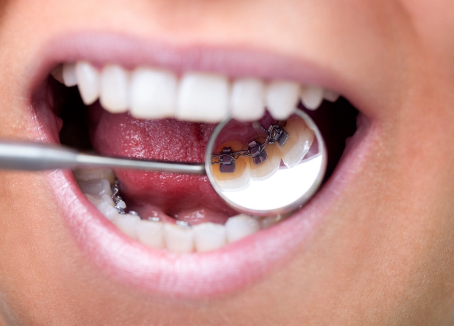 Adult braces in St. George, A persons mouth with a dentist mirror inside