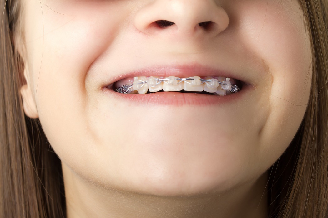 School-friendly orthodontic options, A girl with braces smiling